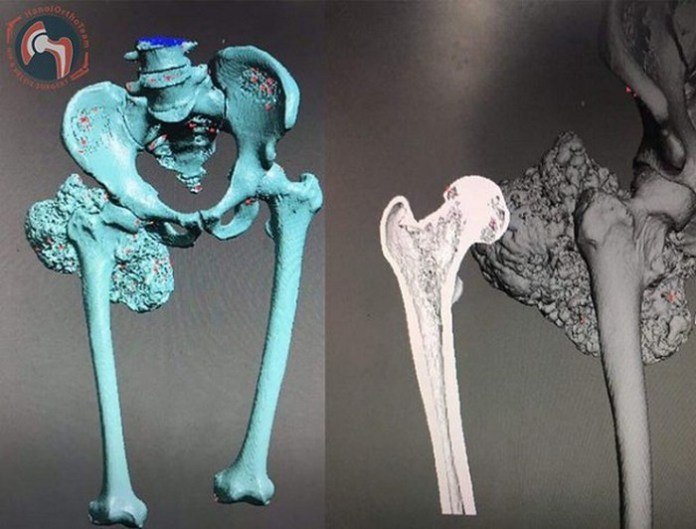 Kỳ tích y học Việt Nam: Thay xương đùi bằng xương nhân tạo in 3D